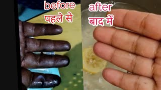 How to Remove Hair Dye from skin  घंटो का काम मिंटो में  Dye hatho se nikale chutkiyo main [upl. by Karina925]