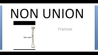 Orthopedics 067 Non Union Fracture Cause Delayed Types Diagnosis Treament Ilizarov’s method [upl. by Atronna]