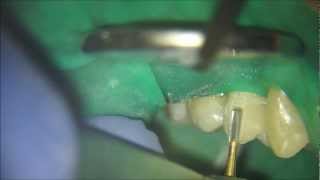 CEREC Crown Removed using the Forrest Tech [upl. by Carlynn]