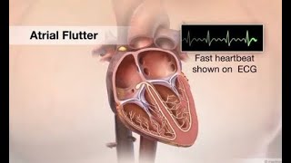 ECG Interpretation Atrial Flutter Explained [upl. by Cadell]