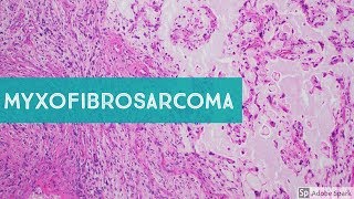 Myxofibrosarcoma 101Explained by a Sarcoma Pathologist [upl. by Lynnette]