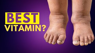 1 Vitamins to GET RID of SWELLING in Feet and Legs  EDEMA [upl. by Arema]