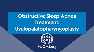 Obstructive Sleep Apnea Treatment Uvulopalatopharyngoplasty [upl. by Hildagard]