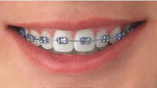 Tipos de Brackets [upl. by Ruthann]