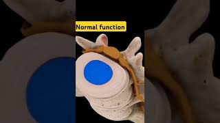 Vertebral Disc Herniation Animation [upl. by Yi]