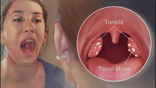 How to get rid of tonsil stones🤮 [upl. by Iliram]