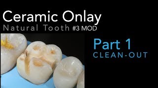 Lithium Disilicate Ceramics Part 1 Ceramic Onlay CleanOut 3 MOD [upl. by Hoxie]