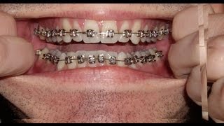 Braces  Photo taken every day  Before and After Transformation  Orthodontics Timelapse [upl. by Vite]