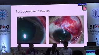 AIOC2024 GP6 Topic Dr Shams Noman Management of Neovascular Glaucoma [upl. by Irollam]