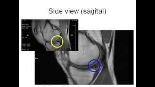 How to Read Knee MRI of Torn Meniscus  Meniscal Tear  Santa Fe Albuquerque Orthopedic Surgeon [upl. by Yelhak]