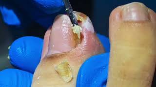 WARNING Dont Try to Remove an Ingrown Toenail Without Watching This [upl. by Lac]