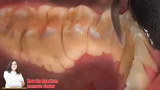 Tartar removal from teeth UNBELIEVABLY GIGANTIC TARTAR tartar and calculus Dentist Scaling [upl. by Noired]