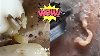 Ultimate Pimple Popping Compilation  Extreme Acne Treatment  Satisfying Blackhead Removal [upl. by Humfried]