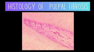 Histology of Pulpal Fibrosis  Dentistry [upl. by Mor]