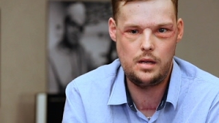 Face Transplant Links Men Touched by Tragedy [upl. by Allenrac]