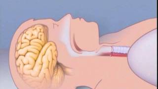 What Is Sleep Apnea [upl. by Charleton]