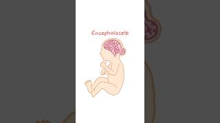 Types of Neural Tube Defects Anencephaly and Encephalocele [upl. by Aneryc797]