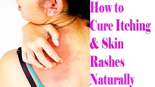 3 Most Effective And Easy Home Remedies For Itchy Skin  How to Cure Itching amp Skin Rashes Naturally [upl. by Swihart]