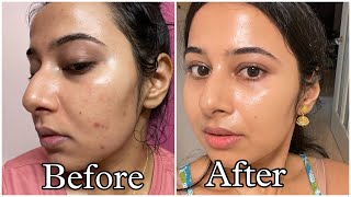 Simple Tretinoin Night Skincare Routine for Acne free Glowing Skin skincare skincareroutine [upl. by Roselin]