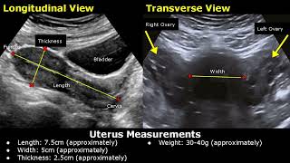 How To Measure Uterus On Ultrasound  Uterine Length Width AP Thickness Measurements TATVS USG [upl. by Nonarb190]