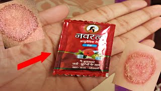 दाद खाज खुजली कितना भी पुराना हो यह तेल लगा लो एक ही दिन में छुट्टी कर देगाfungal ringworm oil [upl. by Seymour]