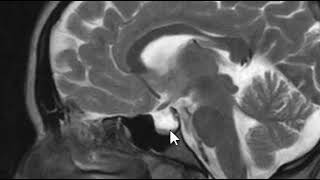 Pseudotumor Cerebri  Brain Scan MRI [upl. by Oberon929]