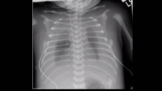 whats the most common cause of pleural effusion in neonates chylothoraxlymphatic thoracic leakage [upl. by Seabrooke]