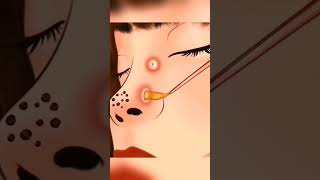 ASMR ASMR acne pointnoirs blackhead [upl. by Akihdar]