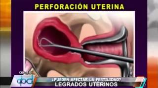 PROCREAR ¿Los legrados uterinos afectan la fertilidad [upl. by Lorrin]