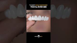 The BEST Smile Makeovers Youll Ever See No Dentist Needed [upl. by Aggarwal]