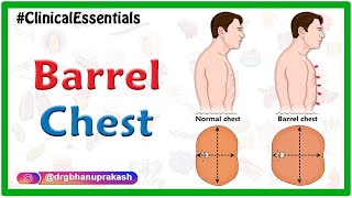 Barrel chest  Clinical essentials [upl. by Iak]