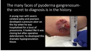 Faces of Pyoderma Gangrenosum [upl. by Rozella]