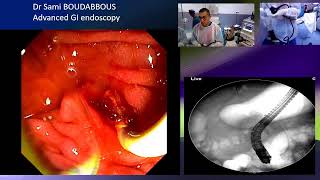 ERCP for acute cholangitis [upl. by Anahsahs]