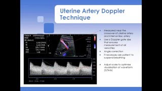 Advanced Fetal Doppler Webinar with Piotr Niznik [upl. by Ziladnerb966]