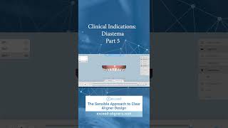 Clinical Indications Diastema Part 5 [upl. by Nrobyalc]