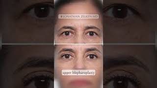 Blepharoplasty EXPLAINED by a board certified plastic surgeon [upl. by Ajiak]