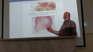 cranial defects and congenital anomalies of cerebral hemispheres by Dr Wahdan [upl. by Langsdon]