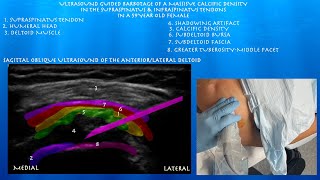 Ultrasound Guided Barbotage of Massive Calcific Tendinitis Supraspinatus and Infraspinatus Tendons [upl. by Tulley]