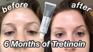 6 Month TretinoinRetinA Update Before amp After  My Current Skincare Routine [upl. by Babita]