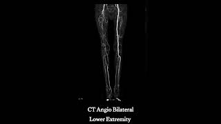 Tissue damage following tourniquet application [upl. by Etteloiv485]