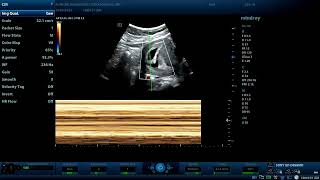 A 6WKs GA missed abortion and subchorionic hematoma  Diagnostic ultrasound cases [upl. by Annayi72]