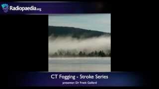 Stroke Fogging phenomenon on CT  radiology video tutorial [upl. by Aihseit]