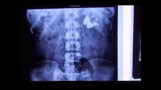 Intravenous Pyelogram  Intravenous Nephrogram  Intravenous Pyelography IVP in Staghorn Calculus [upl. by Aimahc]