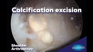 Shoulder arthroscopy calcification excision by Rupen Dattani London [upl. by Llemej457]