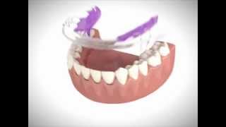 Inman Aligner Introduction Video [upl. by Dumas]