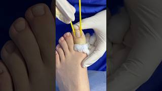 Cauterización química satisfying ingrowntoenailsurgery nails [upl. by Moria]