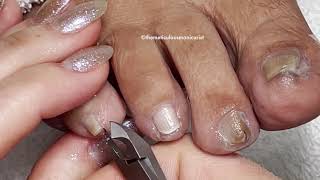 How To Conservative Care at Home Ingrown Toenail [upl. by Aimahs]