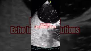 Patent Foramen Ovale echocardiography echocardiogram cardiology [upl. by Baum]