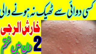 Kharash الرجی ka ilaj alarji خارش ka fori ilaj itching skin alarji ilaj [upl. by Anhaj]