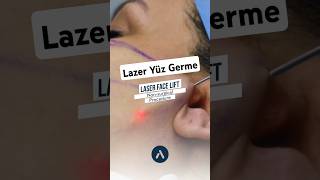 Lazerle Yüz Germe ✨  Ameliyatsız Yüz Germe yüzgerme [upl. by Field637]